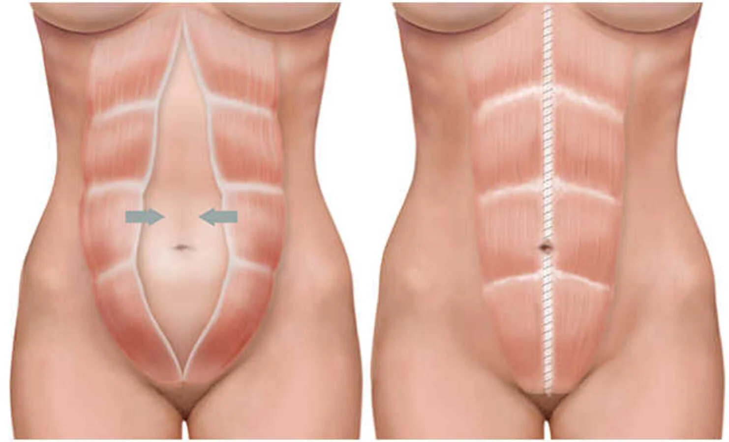 Abdominoplastia Lipoescultural: Esculpe tu abdomen y recupera tu figura