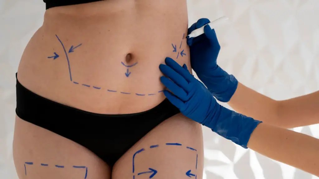 Abdominoplastia Lipoescultural: Esculpe tu abdomen y recupera tu figura