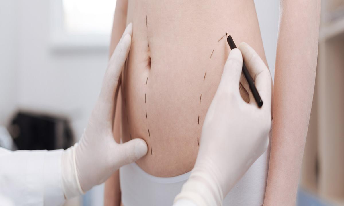 Proceso de liposucción en clínica de Perú