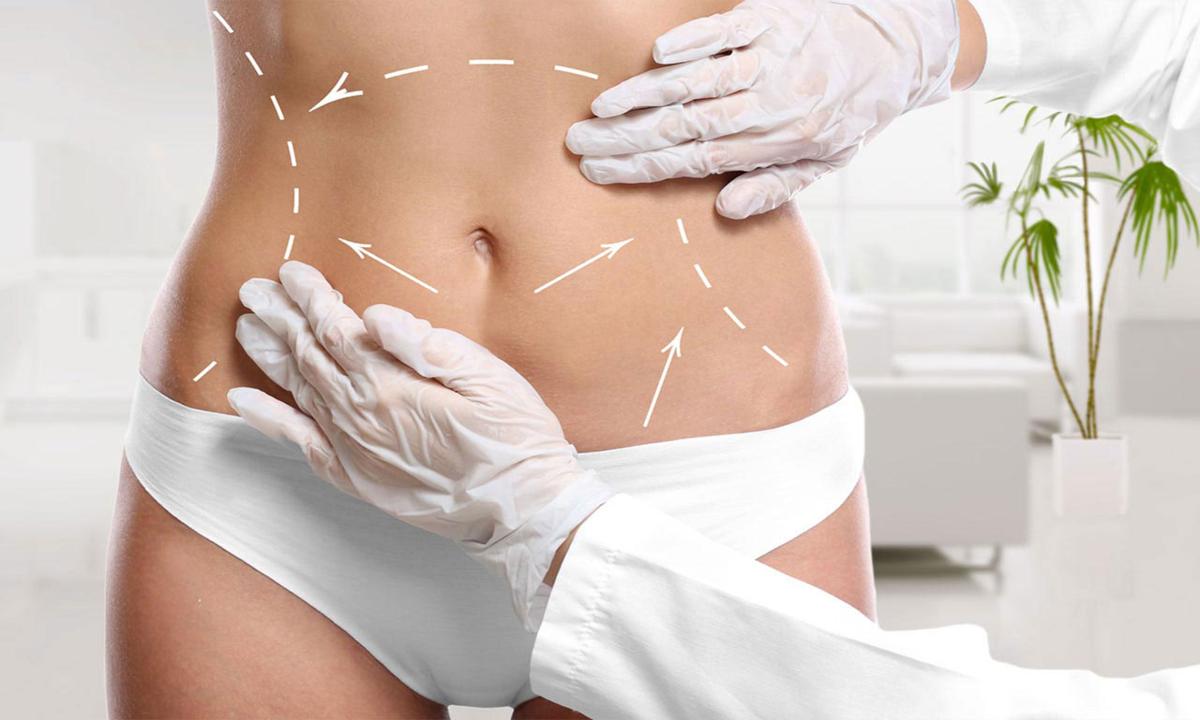 Mejores Técnicas de Liposucción en Perú: Descúbrelo Aquí