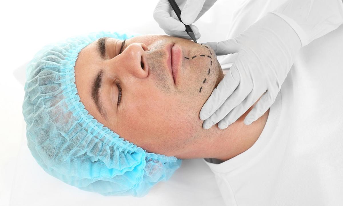 Mentoplastia en Perú: Mejora tu Equilibrio Facial