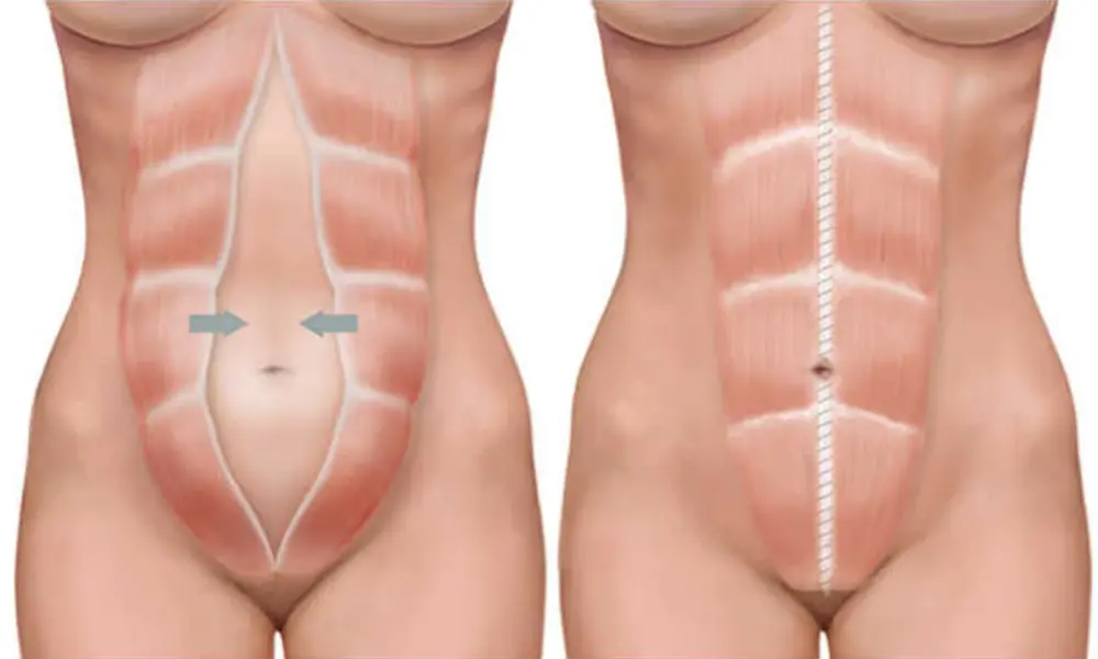 Liposucción en Perú: Todo lo que Necesitas Saber