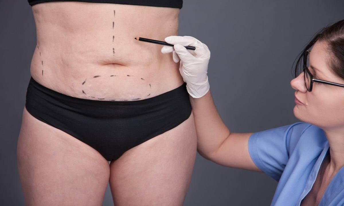 ¿Cuánto Cuesta una Liposucción en Perú? Precios y Detalles