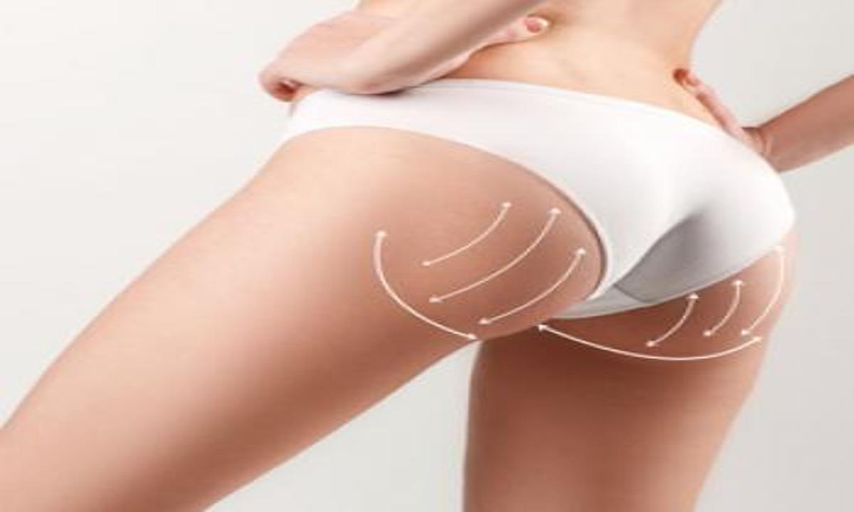 ¿Tienes Hip Dips? La Liposucción es la Solución