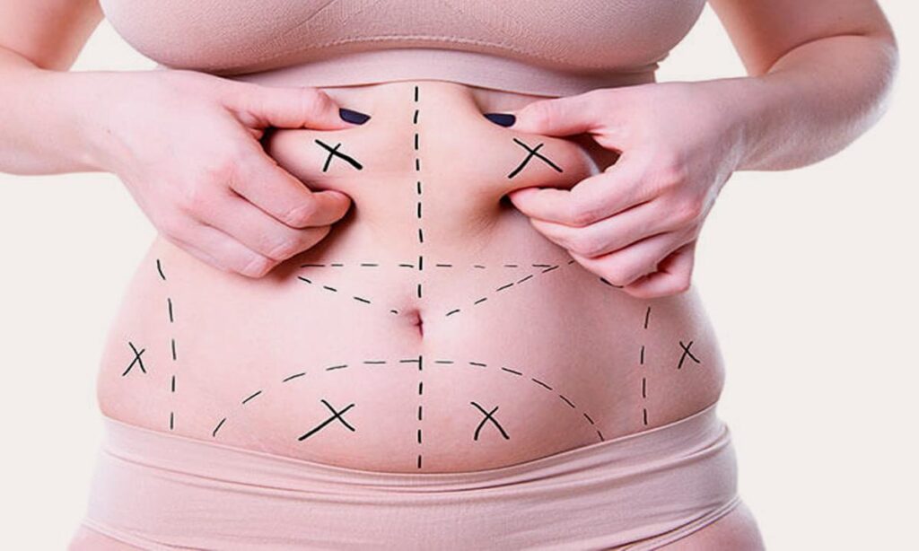 Procedimiento de lipoescultura en abdomen