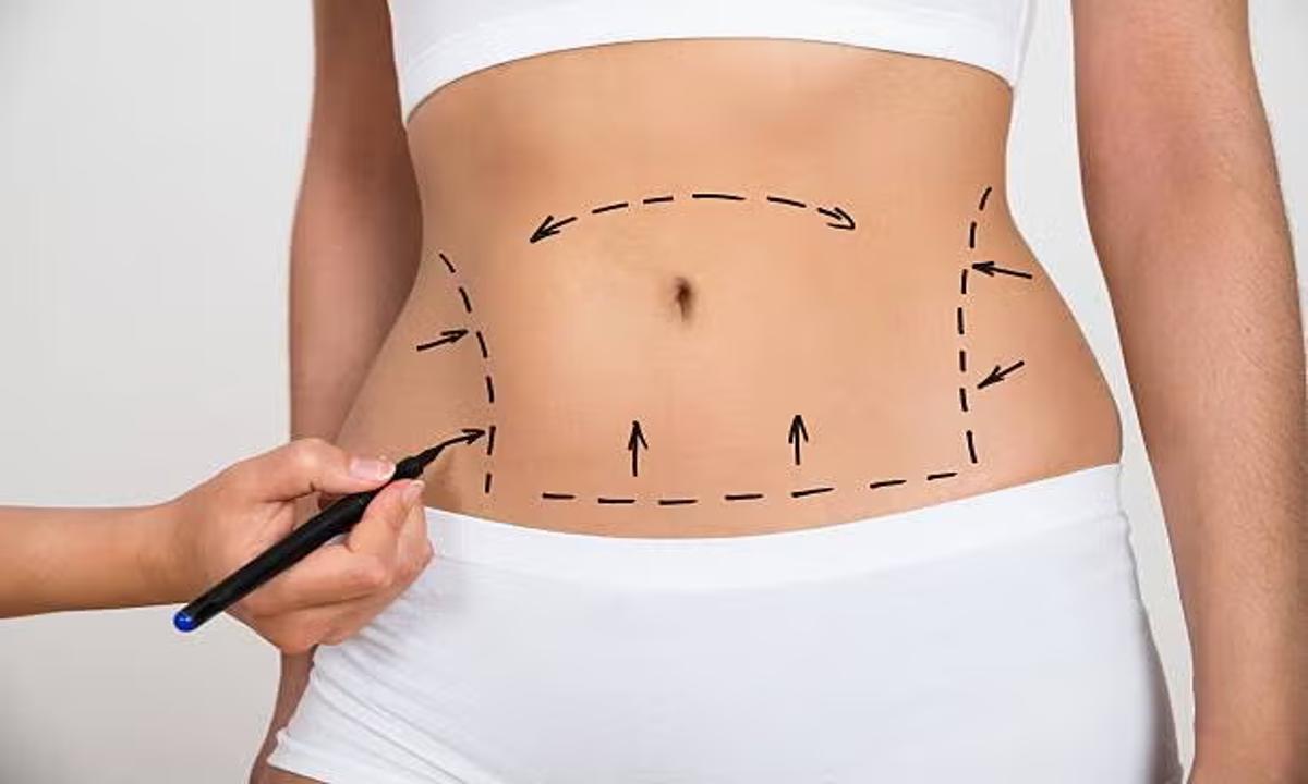 Procedimientos de Mommy Makeover : Cirugías estéticas