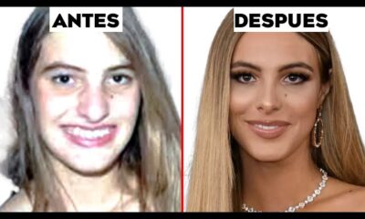 Rinoplastía en Famosos: Transformaciones y Mejora Estética en Celebridades