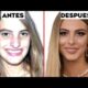 Rinoplastía en Famosos: Transformaciones y Mejora Estética en Celebridades